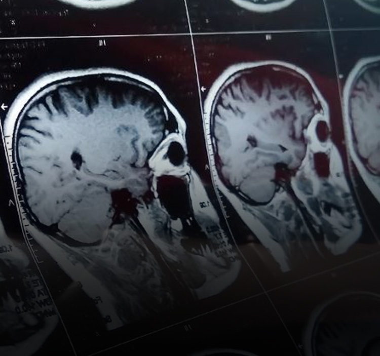 Lesión cerebral traumática